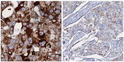 MPC1_favourable_gene_in_lung_cancer_HPA045119.jpg